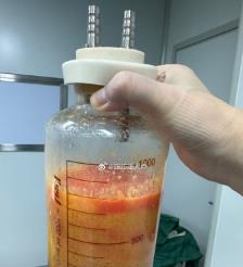 陇南水动力吸脂手术要做多久？